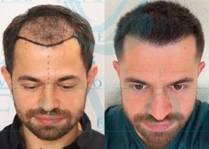 Haartransplantation vorher nachher Bilder