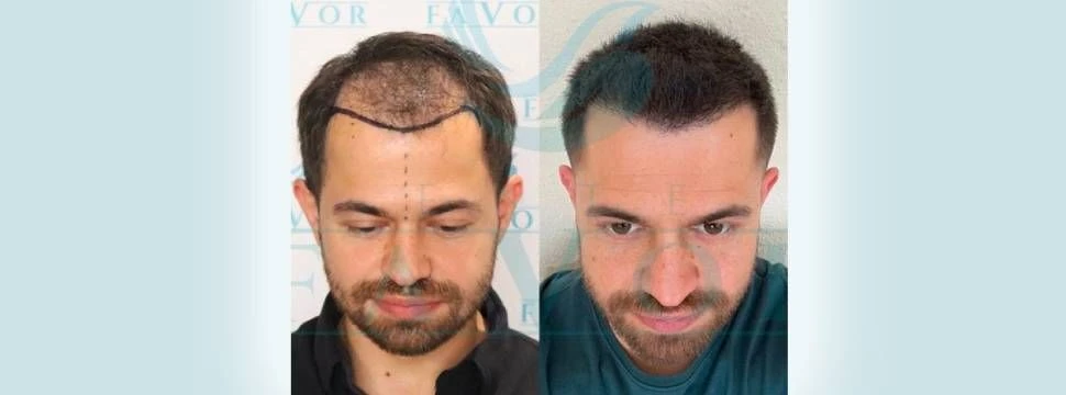Haartransplantation vorher nachher Bilder