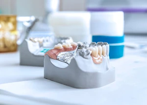 Zahnimplantate mit CAD / CAM Fertigung